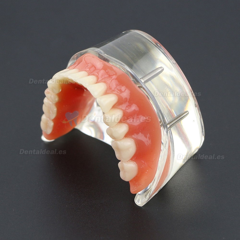 Dientes inferiores dental Modelo de sobredentadura 4 implantes Demostración Modelo 6002 02